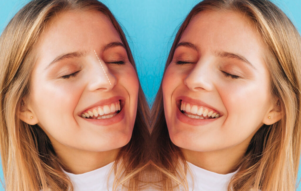 lip flip before and after smile