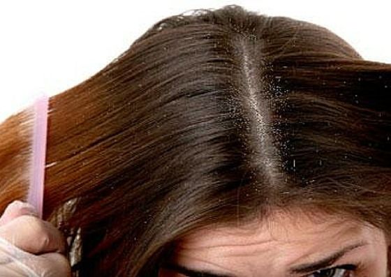 can dandruff cause hair loss