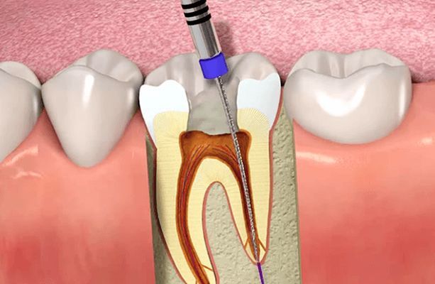 how long do root canals take