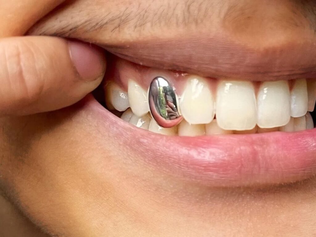 silver caps on teeth