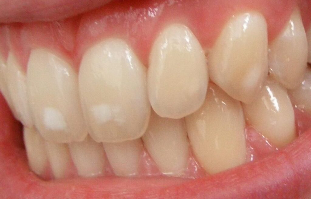white spots on teeth