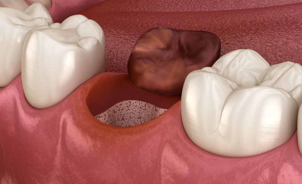 dentist for dry socket